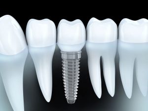 dental implants illustration photo