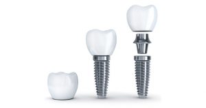 dental implants illustration