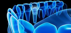 dental implants near me