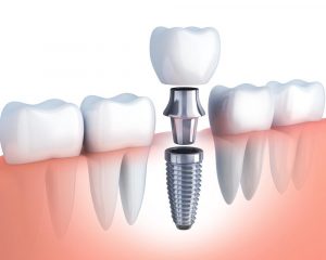 illustration of dental implants photo